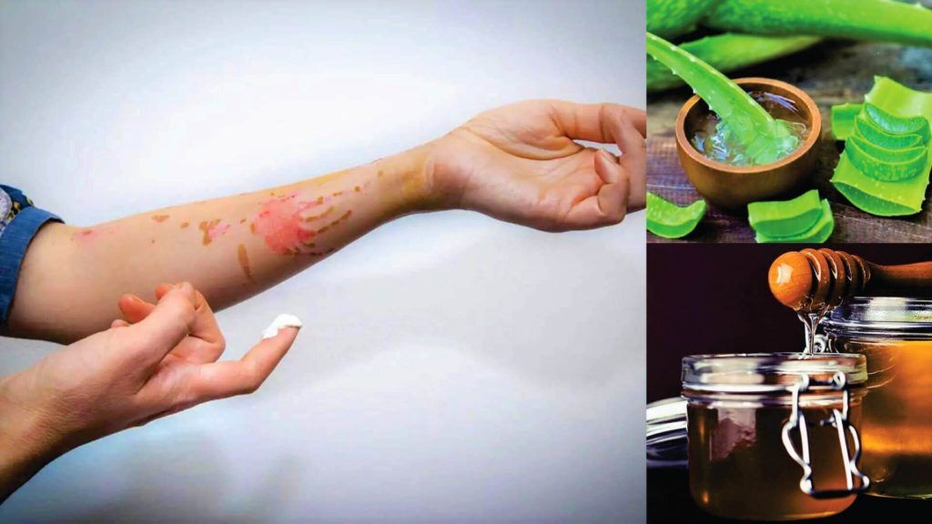 Oil Burn Treatment 10 Easy Ways to Treat It Beauty Tips By Nim